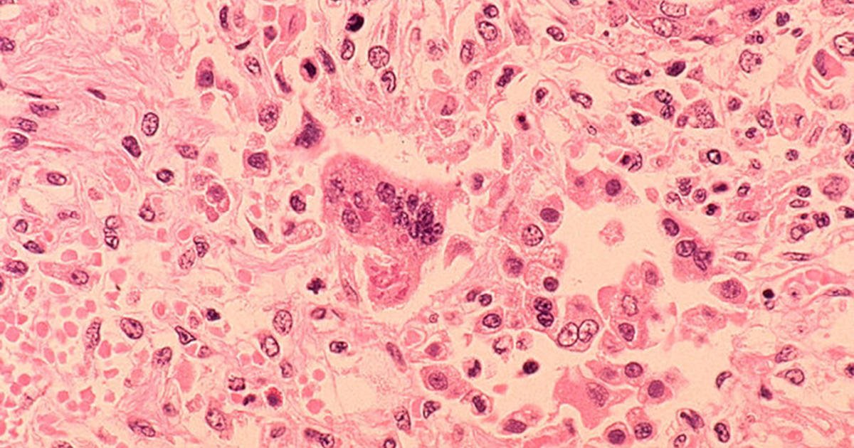 Measles case confirmed in New Jersey, health officials say. Where residents may have been exposed – CBS New York