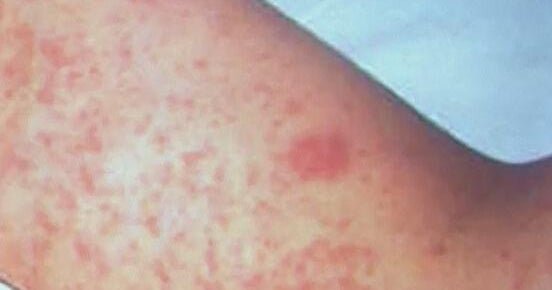 Colorado health officials: recent guests of a hotel may have been exposed to measles – CBS News