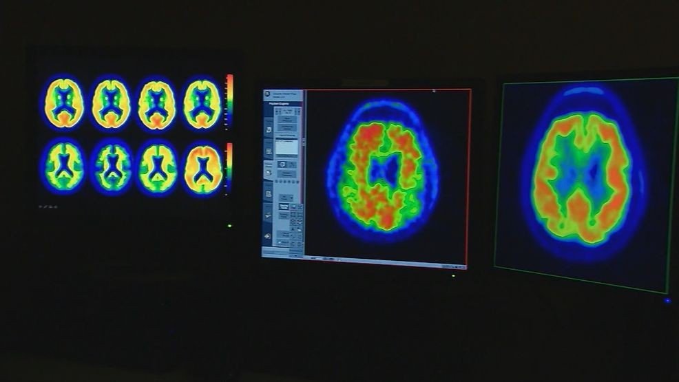 Creatine's role in brain health: What it means for Alzheimer's patients – WJLA Creatine's role in brain health: What it means for Alzheimer's patients – WJLA